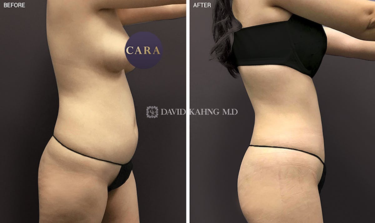 Liposuction Before & After Gallery - Patient 108501627 - Image 1