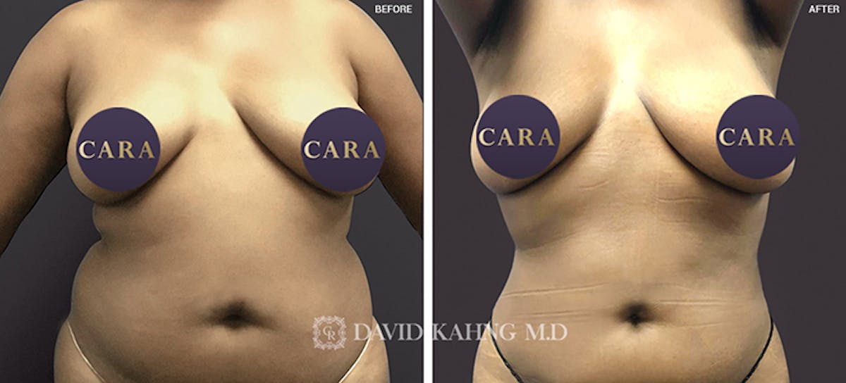 Liposuction Before & After Gallery - Patient 108501628 - Image 1