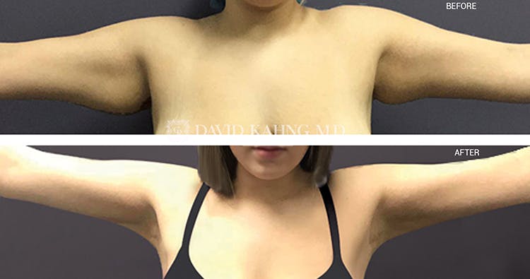 Liposuction Gallery - Patient 108501629 - Image 1