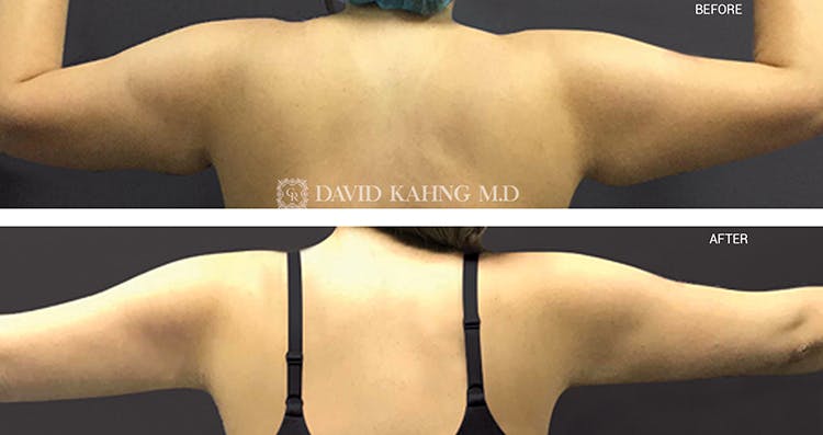Liposuction Gallery - Patient 108501630 - Image 1