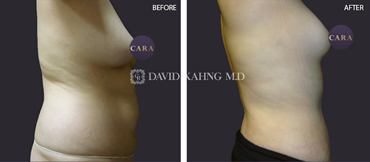 Liposuction Before & After Gallery - Patient 108501631 - Image 1