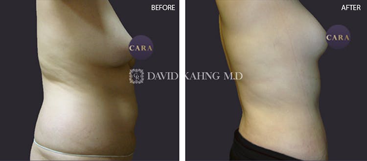 Liposuction Before & After Gallery - Patient 108501631 - Image 1