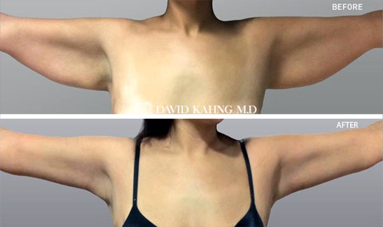 Liposuction Before & After Gallery - Patient 108501632 - Image 1