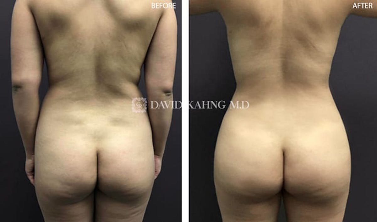 Brazilian Butt Lift Before & After Gallery - Patient 108501638 - Image 1