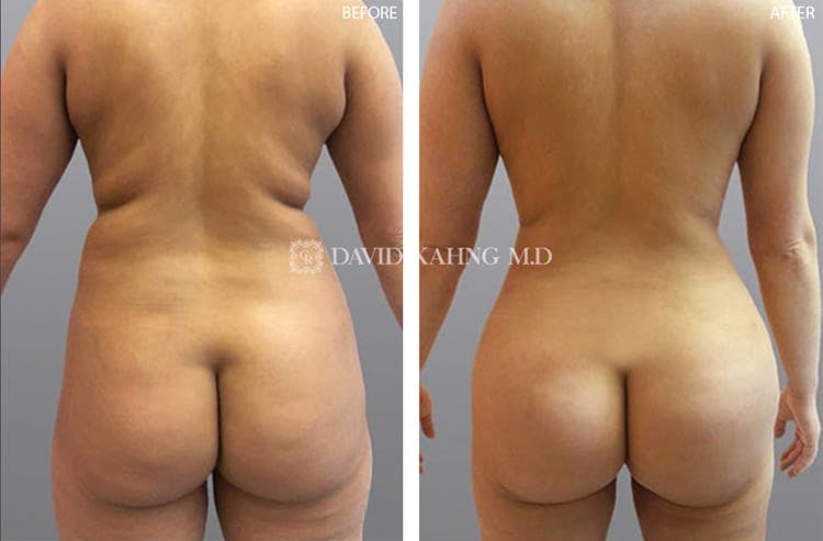 Brazilian Butt Lift Before & After Gallery - Patient 108501639 - Image 1