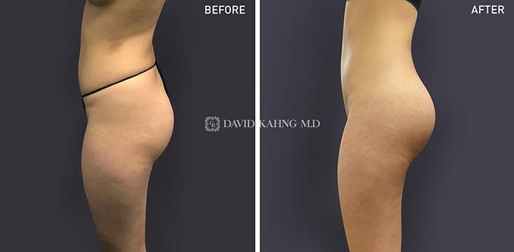 Brazilian Butt Lift Before & After Gallery - Patient 108501643 - Image 1
