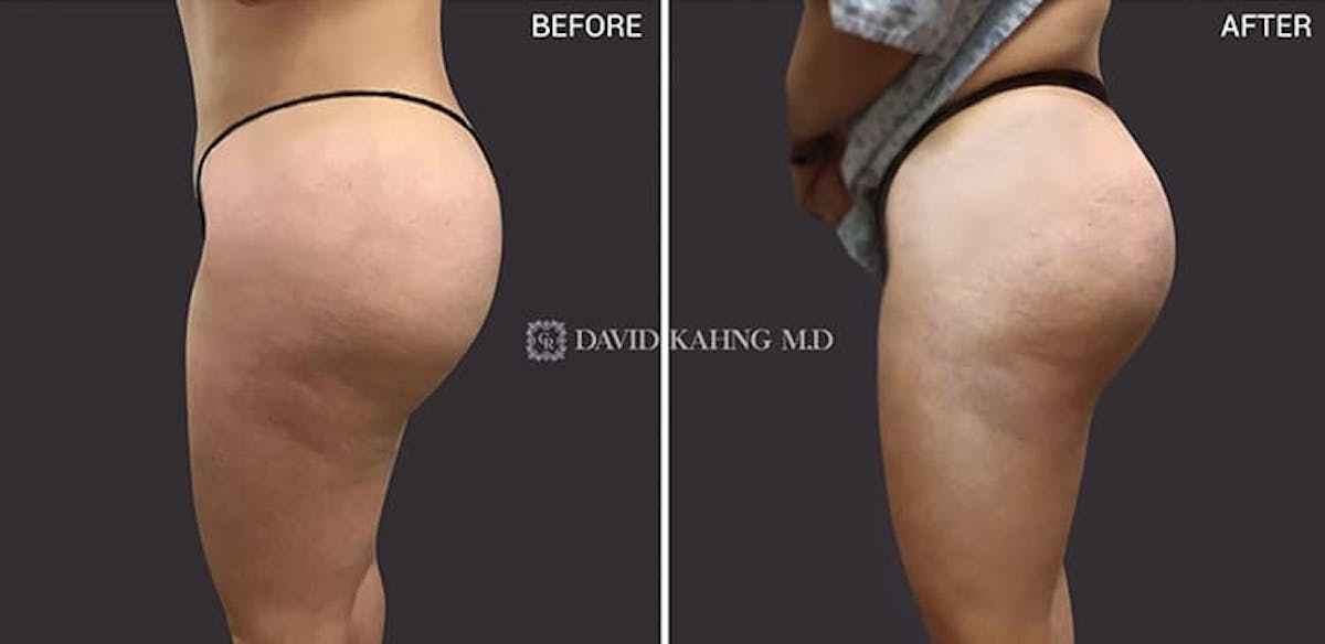 Brazilian Butt Lift Before & After Gallery - Patient 108501644 - Image 1