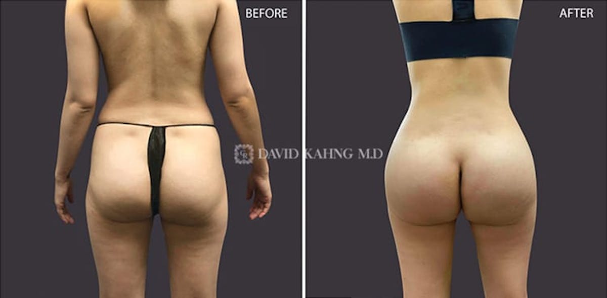 Brazilian Butt Lift Before & After Gallery - Patient 108501636 - Image 1