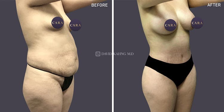 Tummy Tuck Before & After Gallery - Patient 108501708 - Image 1