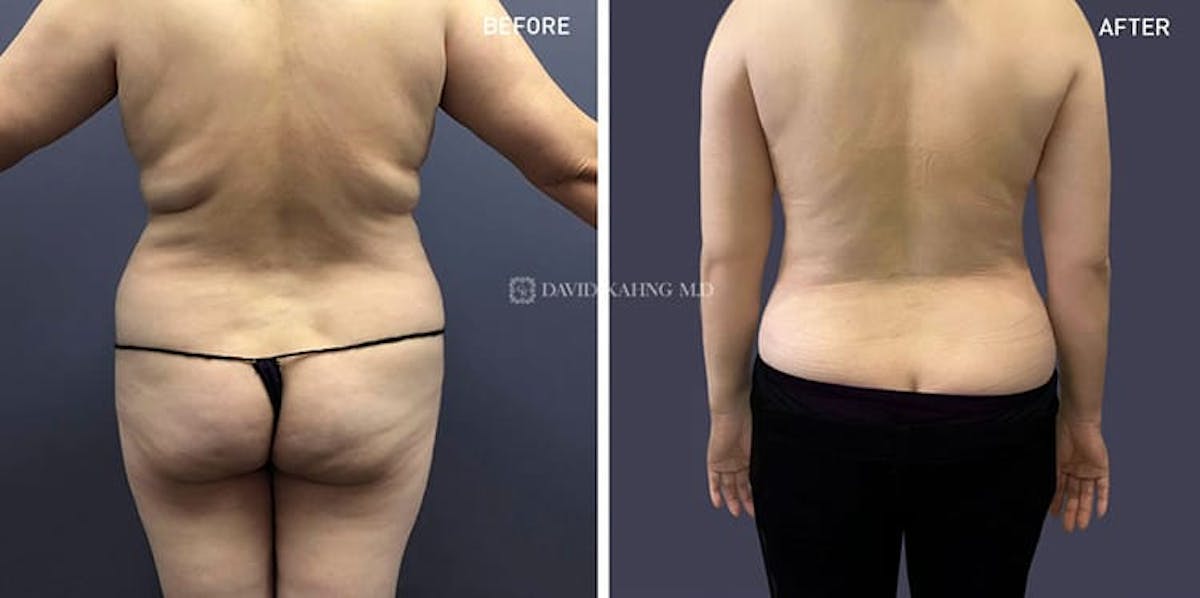 Tummy Tuck Before & After Gallery - Patient 108501709 - Image 1