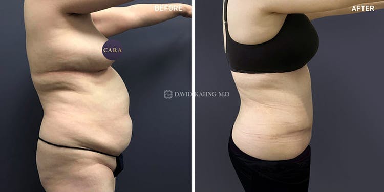 Tummy Tuck Gallery - Patient 108501710 - Image 1