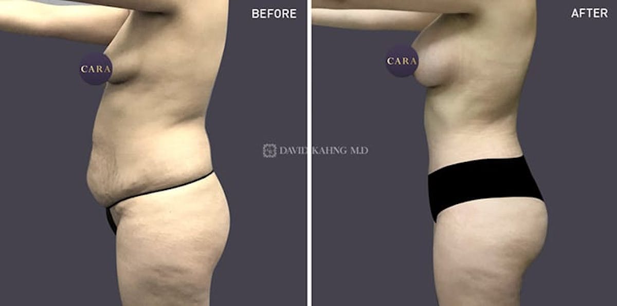 Tummy Tuck Before & After Gallery - Patient 108501712 - Image 1