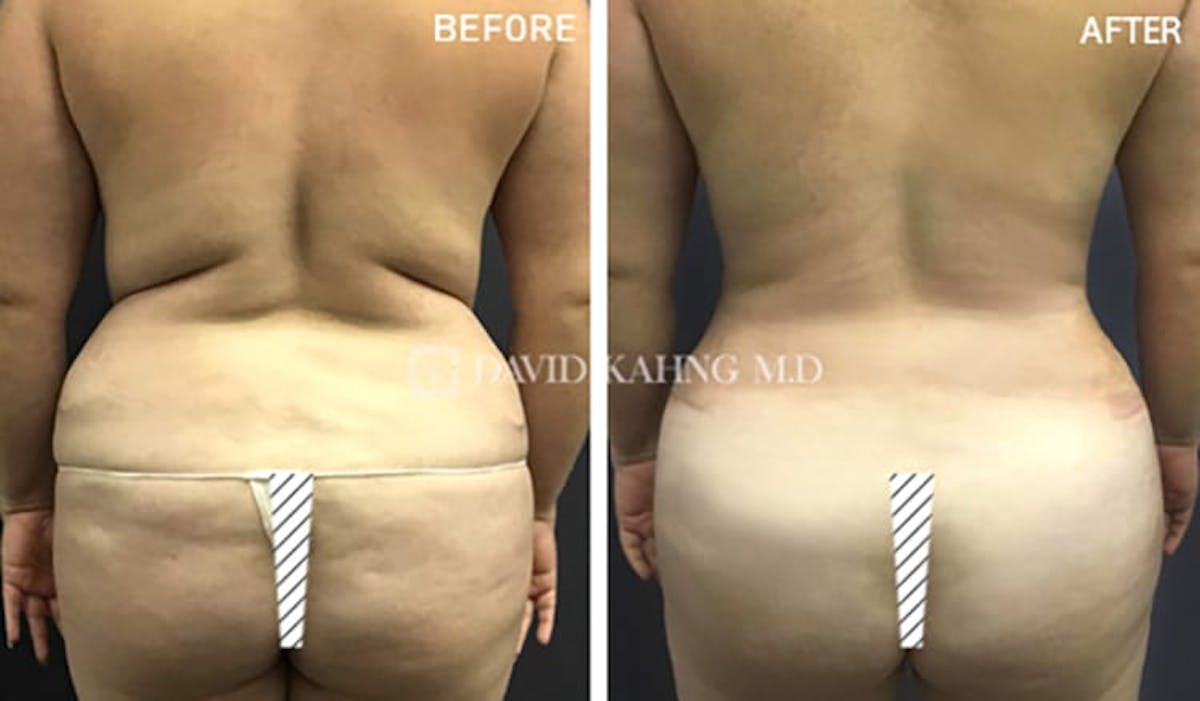 Tummy Tuck Before & After Gallery - Patient 108501713 - Image 1