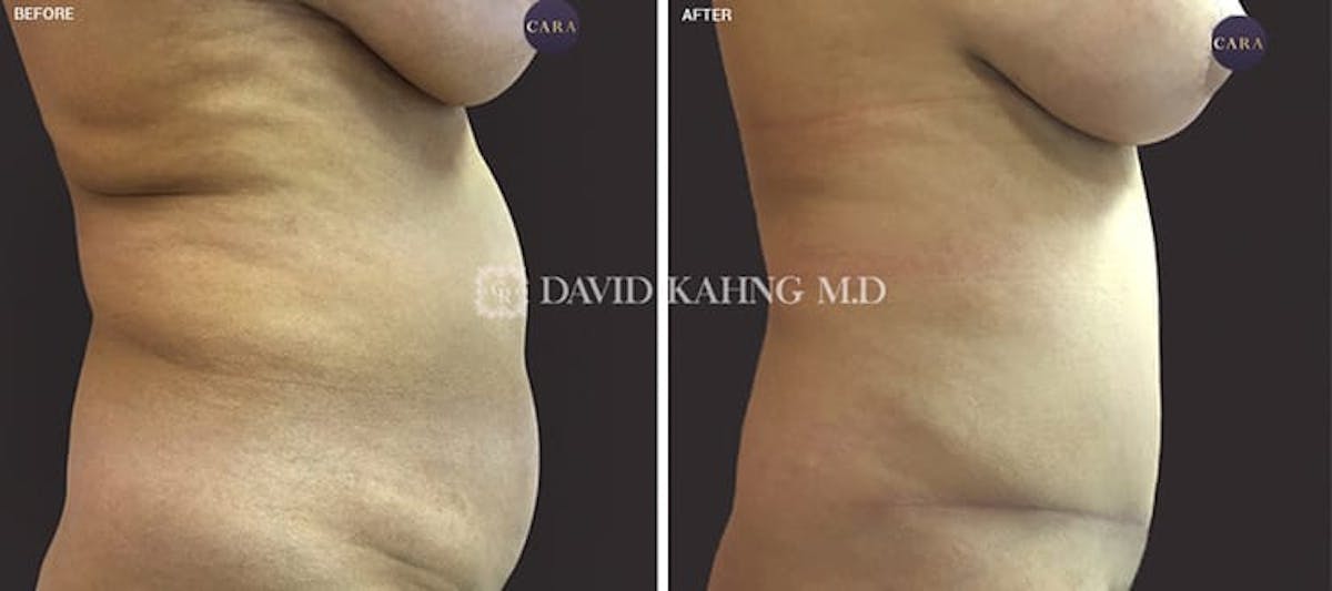 Tummy Tuck Before & After Gallery - Patient 108501714 - Image 1