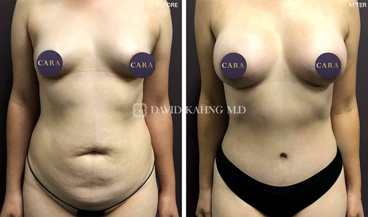 Tummy Tuck Before & After Gallery - Patient 108501715 - Image 1