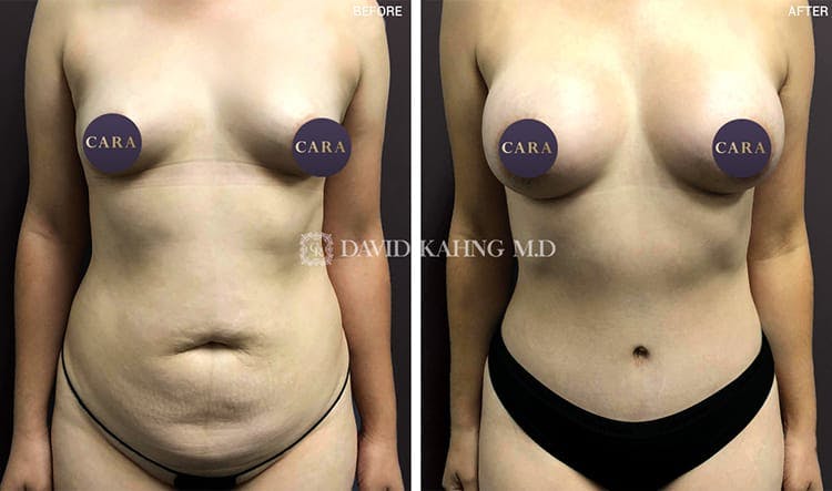 Tummy Tuck Gallery - Patient 108501715 - Image 1