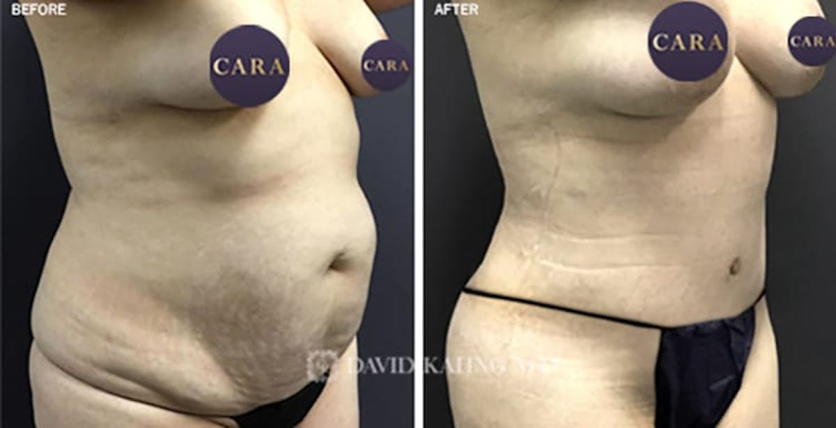 Tummy Tuck Scars Before and After Photo Gallery, Los Angeles, CA