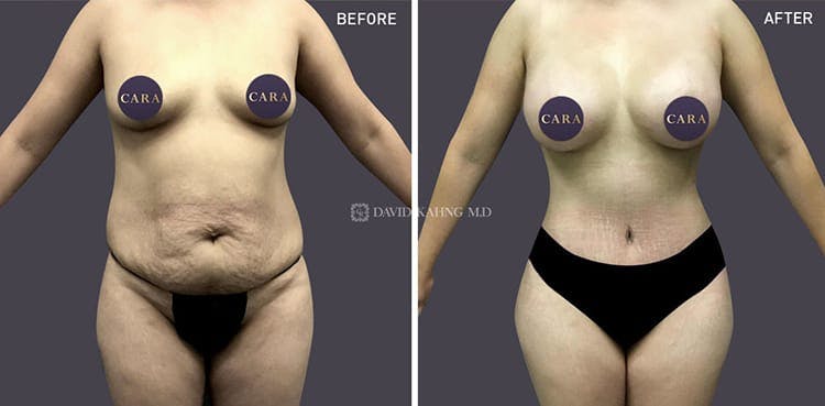 Tummy Tuck Gallery - Patient 108501707 - Image 1