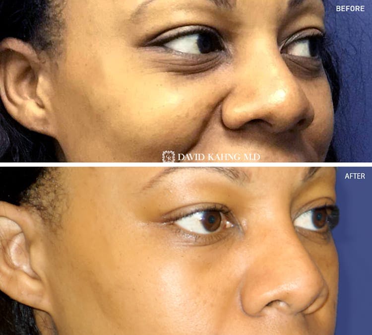 Filler Before & After Gallery - Patient 108501726 - Image 1