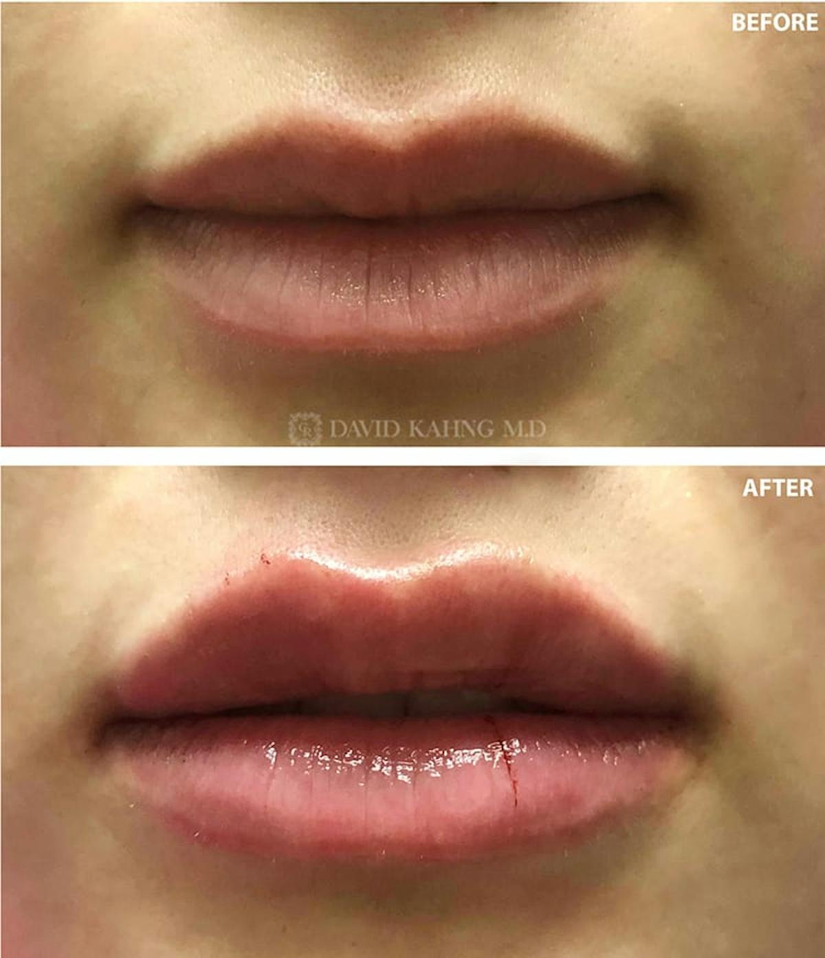 Filler Before & After Gallery - Patient 108501733 - Image 1