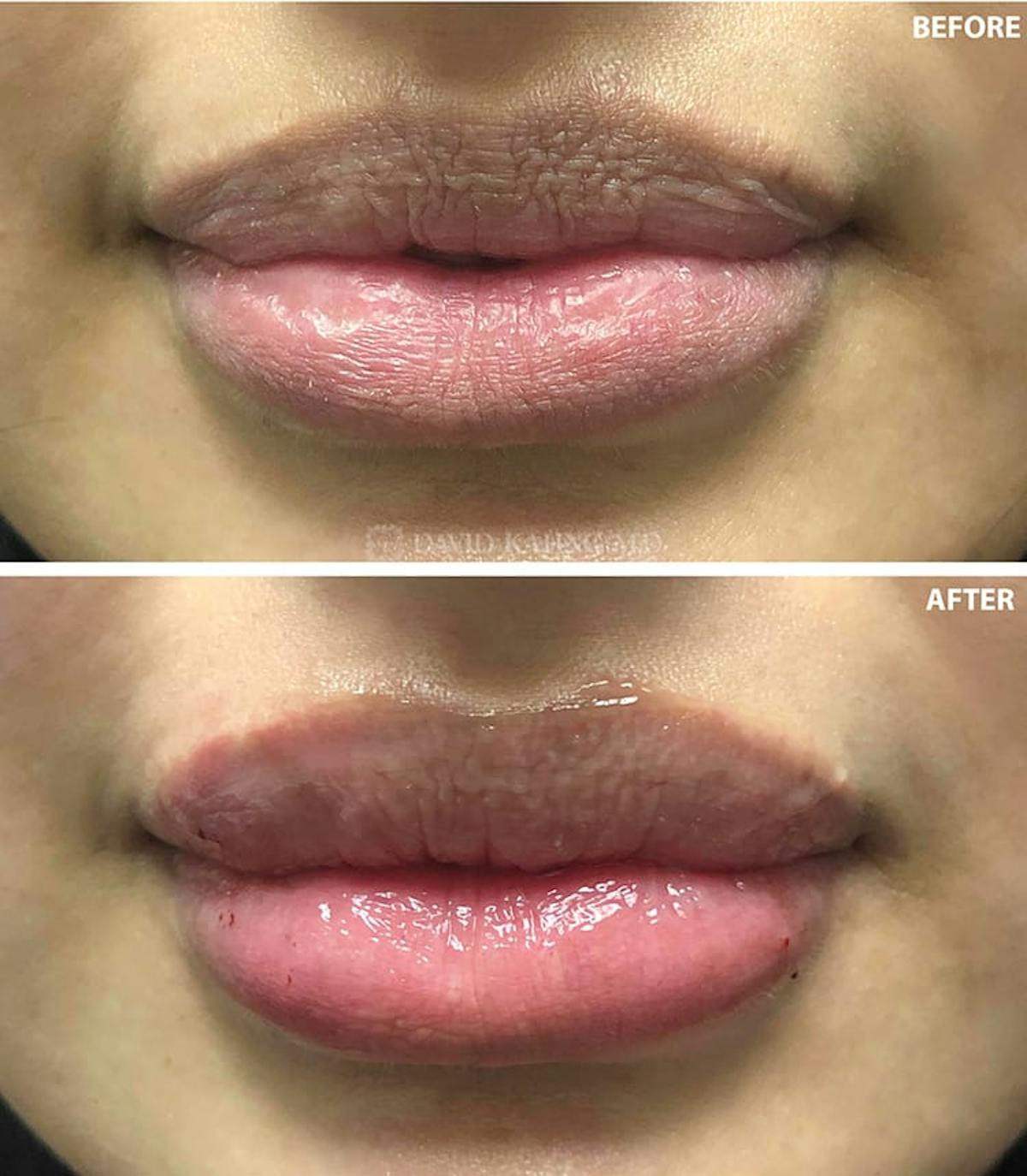 Filler Before & After Gallery - Patient 108501734 - Image 1