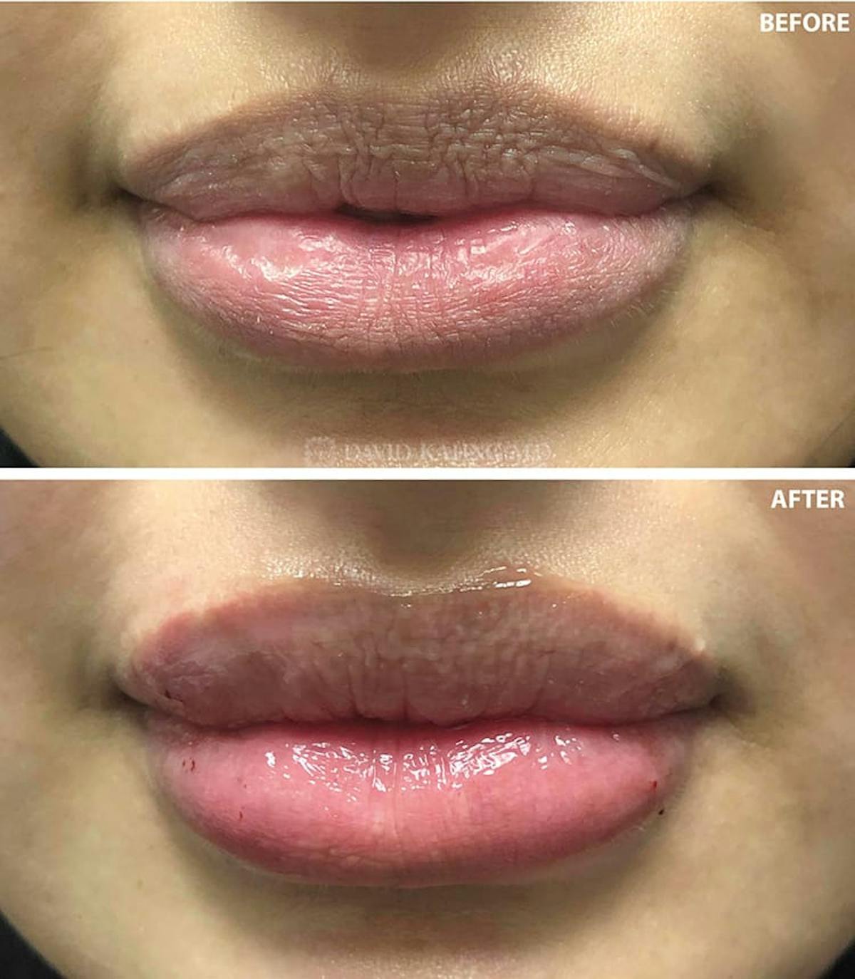 Filler Before & After Gallery - Patient 108501734 - Image 1