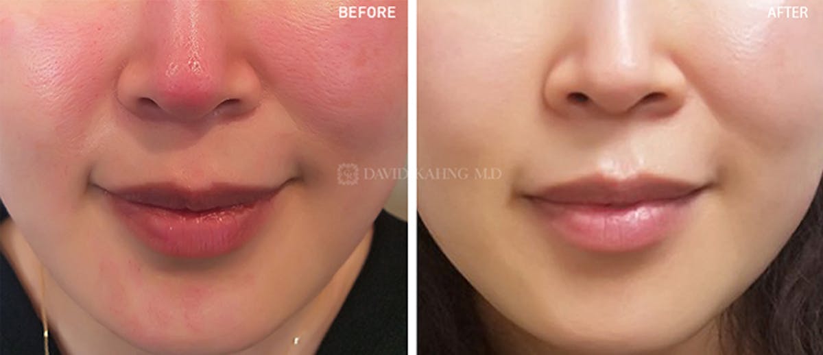 Laser Resurfacing Before & After Gallery - Patient 108501736 - Image 1