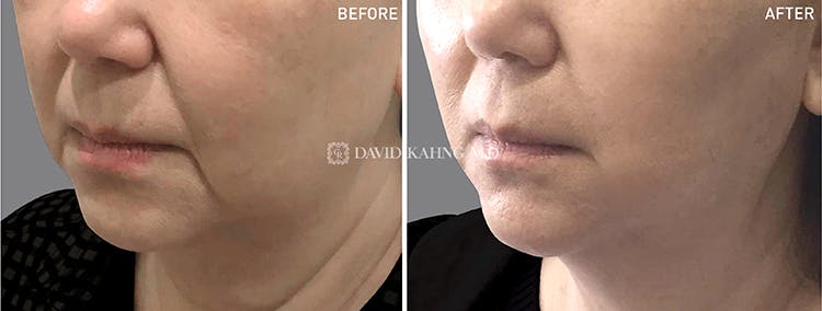 Thread Lift Before & After Gallery - Patient 108506619 - Image 1