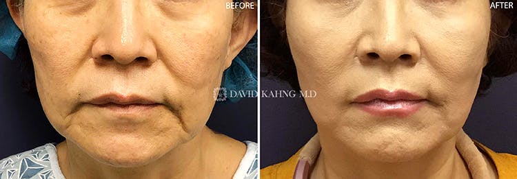 Thread Lift Before & After Gallery - Patient 108506620 - Image 1