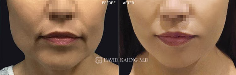 Thread Lift Before & After Gallery - Patient 108506618 - Image 1