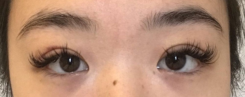 Patient before and after photos of eyelid surgery