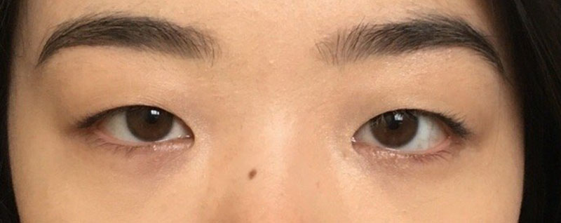 Patient before and after photos of eyelid surgery