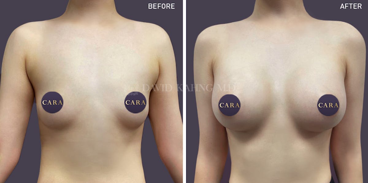 Asian Breast Augmentation Before & After Gallery - Patient 148128740 - Image 1