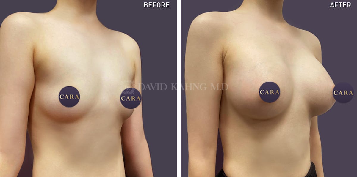 Breast Augmentation Before & After Gallery - Patient 147720801 - Image 3