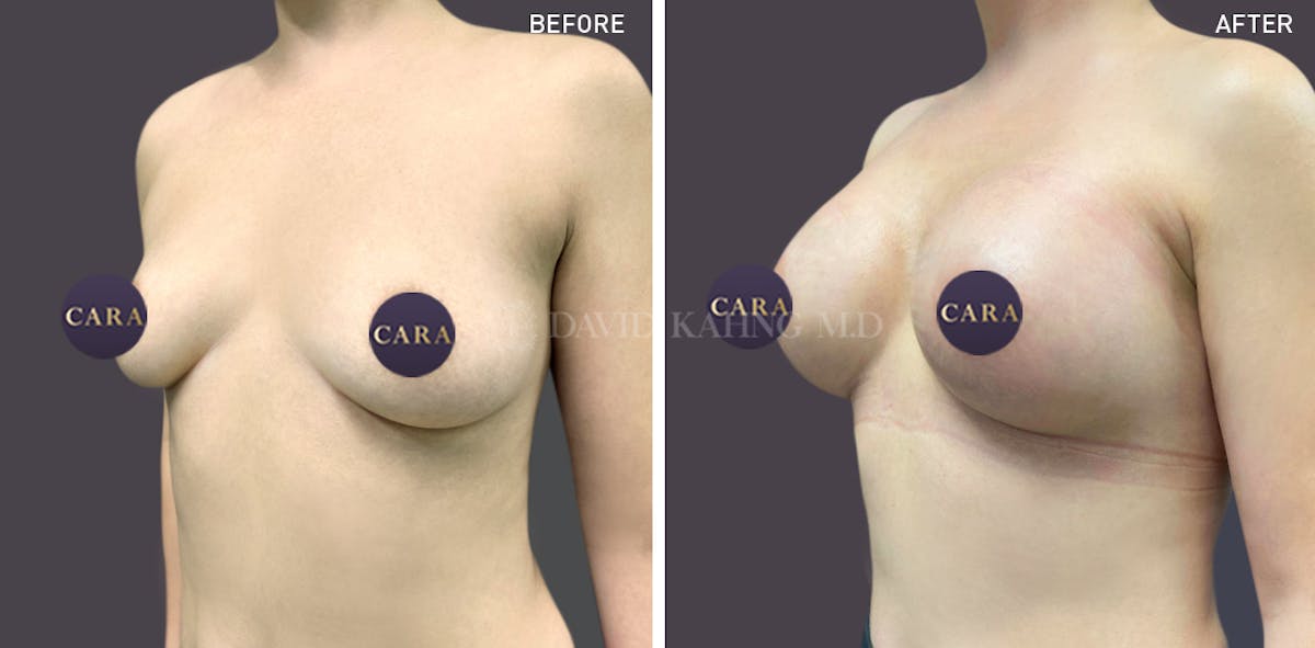 Asian Breast Augmentation Before & After Gallery - Patient 148128746 - Image 1