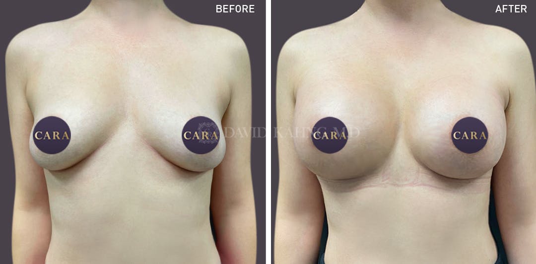 Breast Augmentation Before & After Gallery - Patient 147720802 - Image 1