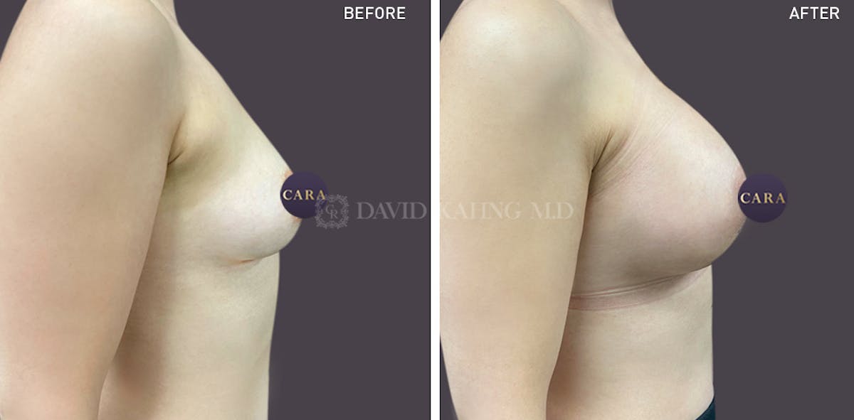 Breast Augmentation Before & After Gallery - Patient 147720802 - Image 3