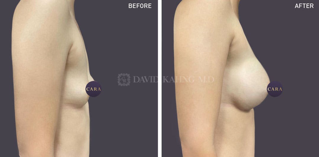 Asian Breast Augmentation Before & After Gallery - Patient 148128752 - Image 1
