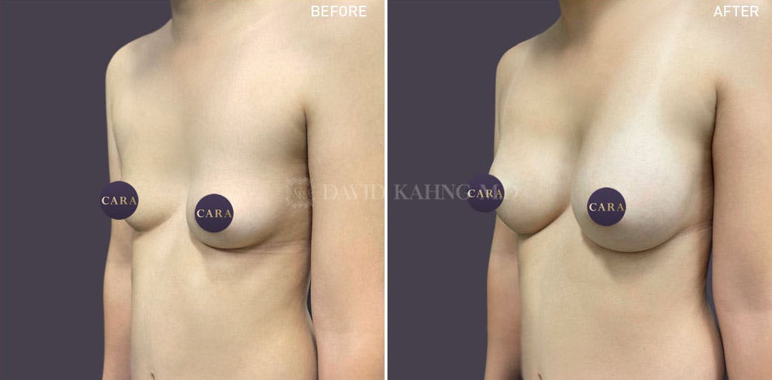 Asian Breast Augmentation Before & After Gallery - Patient 148128754 - Image 1
