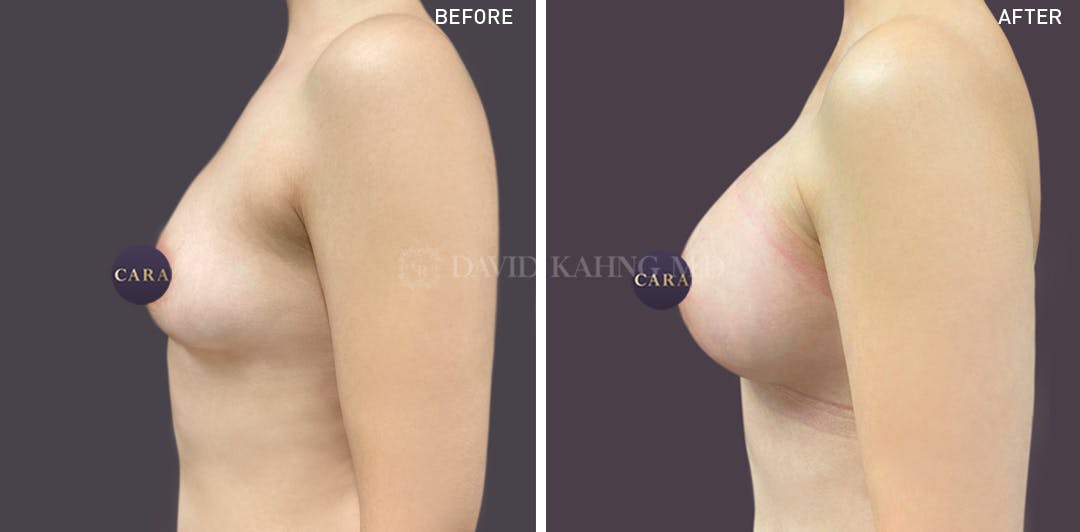 Breast Augmentation Before & After Gallery - Patient 147720802 - Image 4