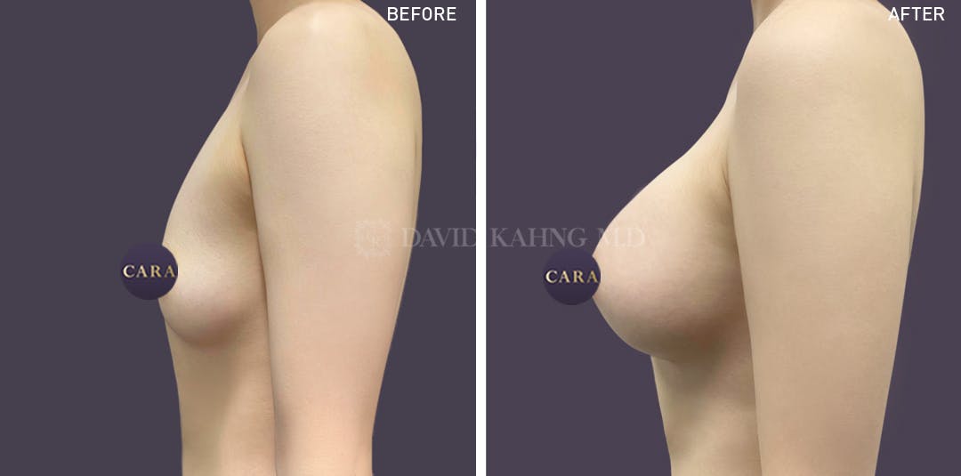 Asian Breast Augmentation Before & After Gallery - Patient 148128742 - Image 1