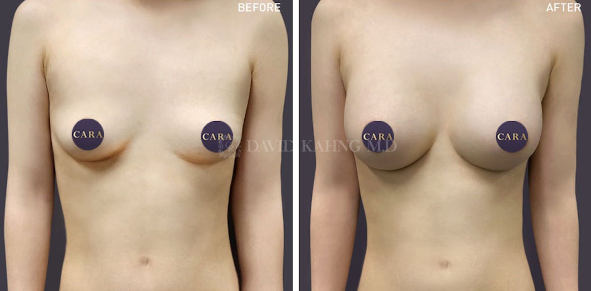 Asian Breast Augmentation Before & After Gallery - Patient 148128743 - Image 1