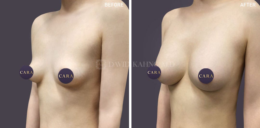 Asian Breast Augmentation Before & After Gallery - Patient 148128744 - Image 1