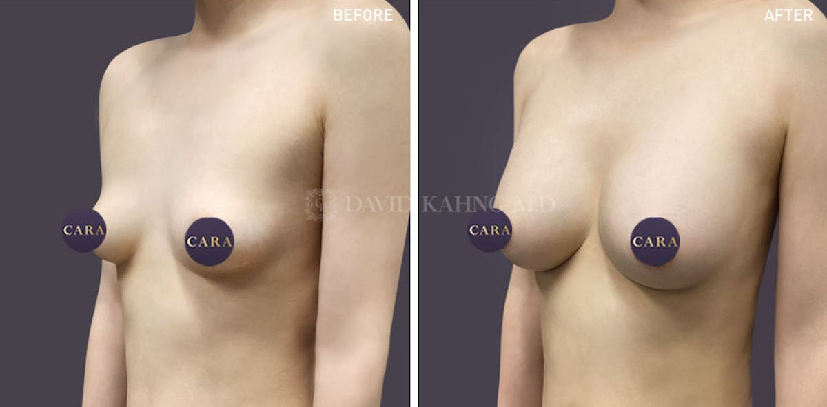 Asian Breast Augmentation Before & After Gallery - Patient 148128744 - Image 1
