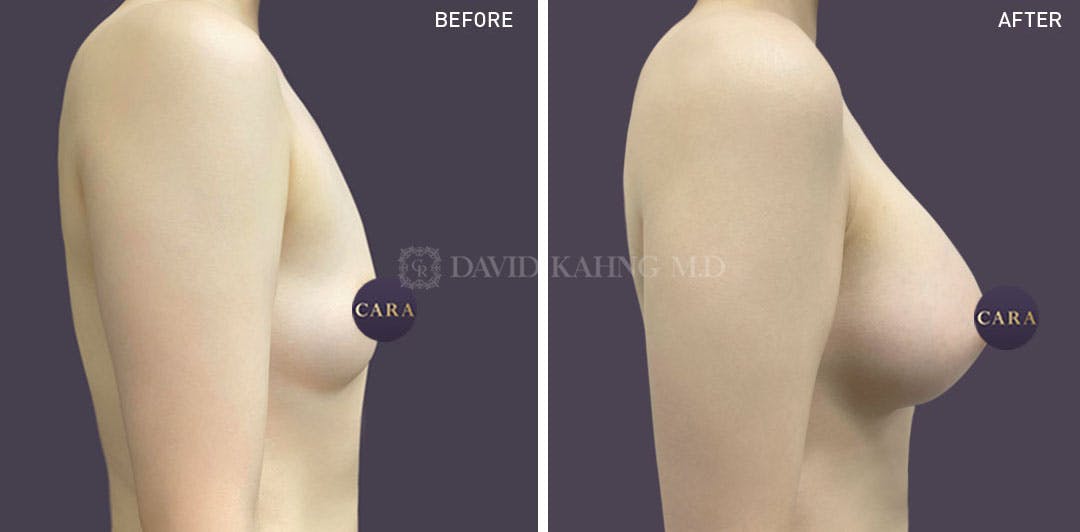 Breast Augmentation Before & After Gallery - Patient 147720822 - Image 1
