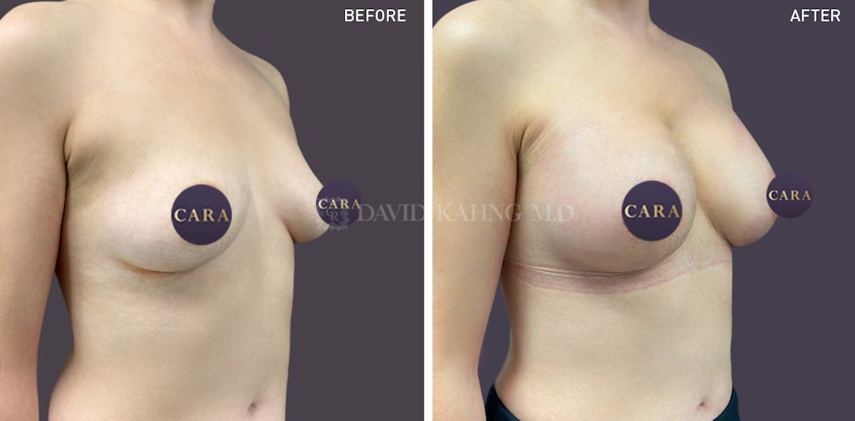 Asian Breast Augmentation Before & After Gallery - Patient 148128750 - Image 1