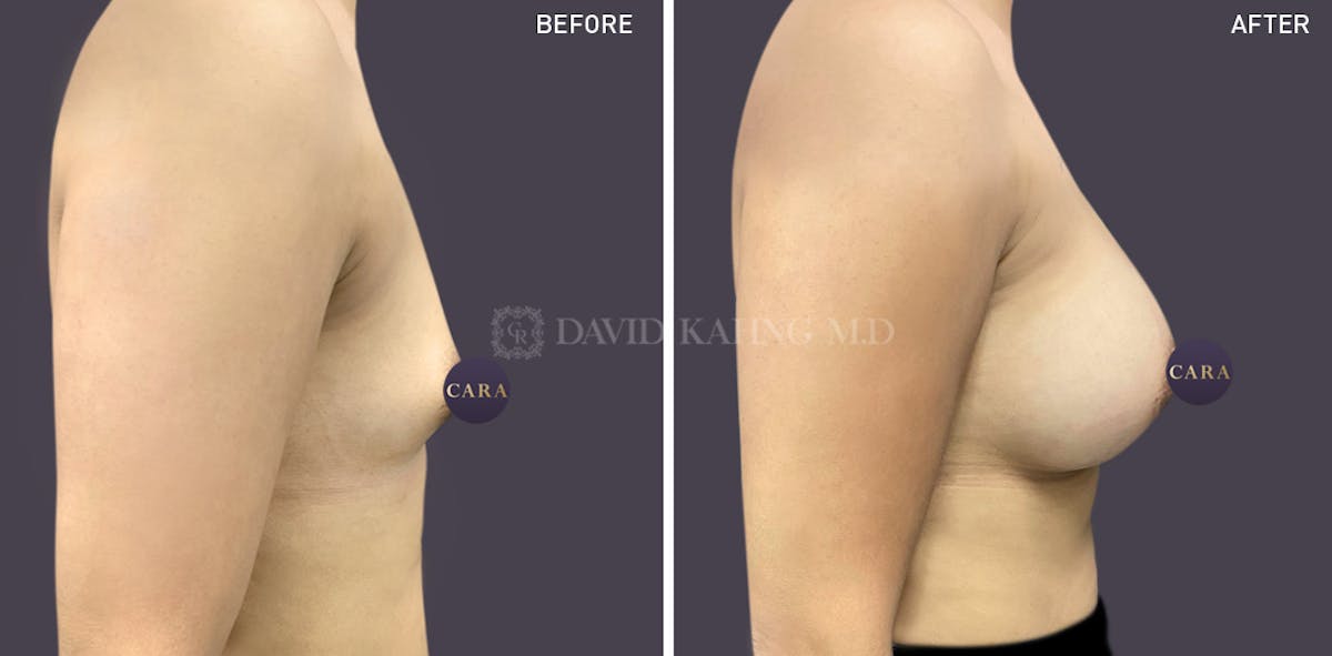 Breast Augmentation Before & After Gallery - Patient 147720824 - Image 1