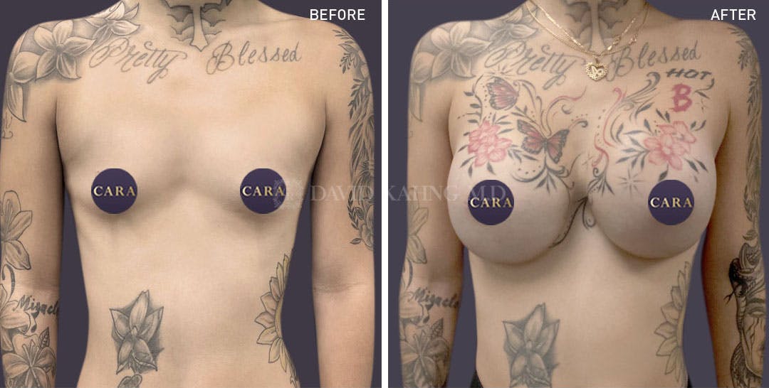 Breast Augmentation Before & After Gallery - Patient 147720820 - Image 1