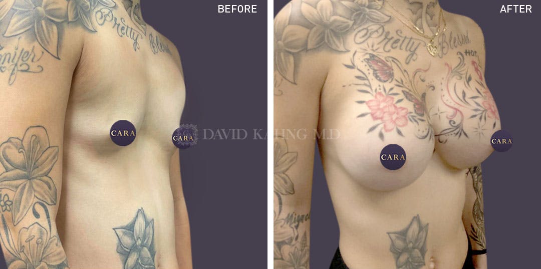 Breast Augmentation Before & After Gallery - Patient 147720820 - Image 3