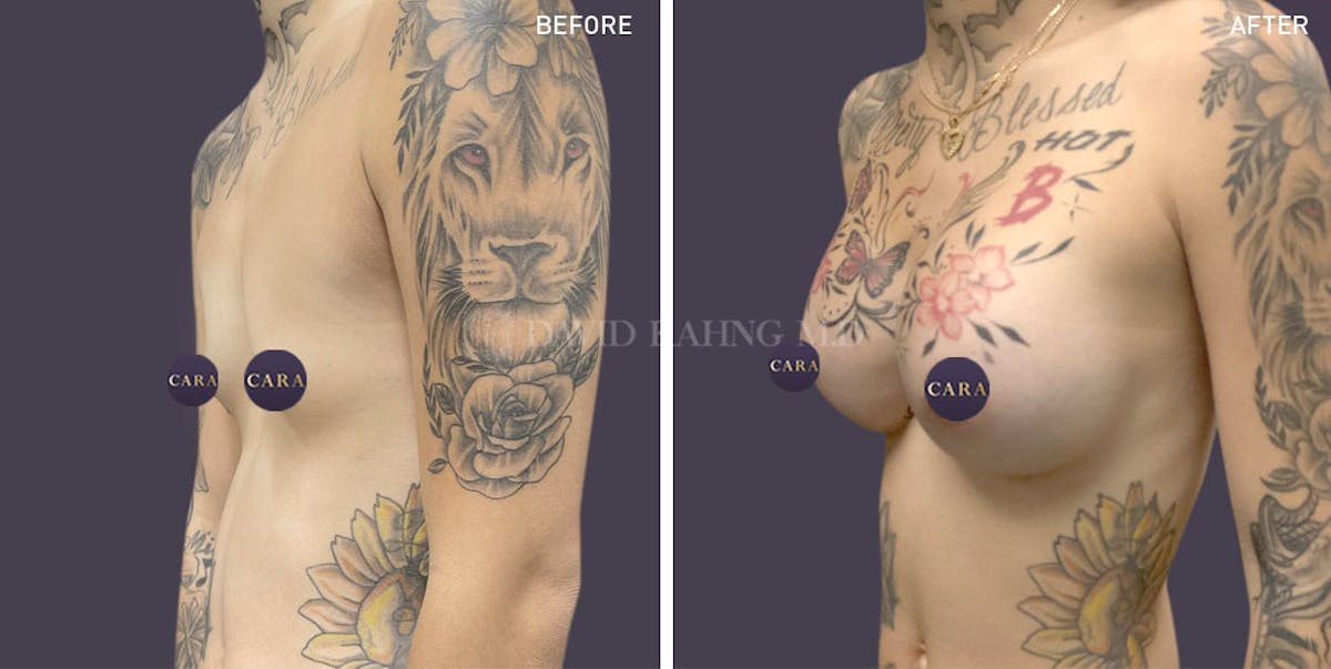 Breast Augmentation Before & After Gallery - Patient 147720820 - Image 4